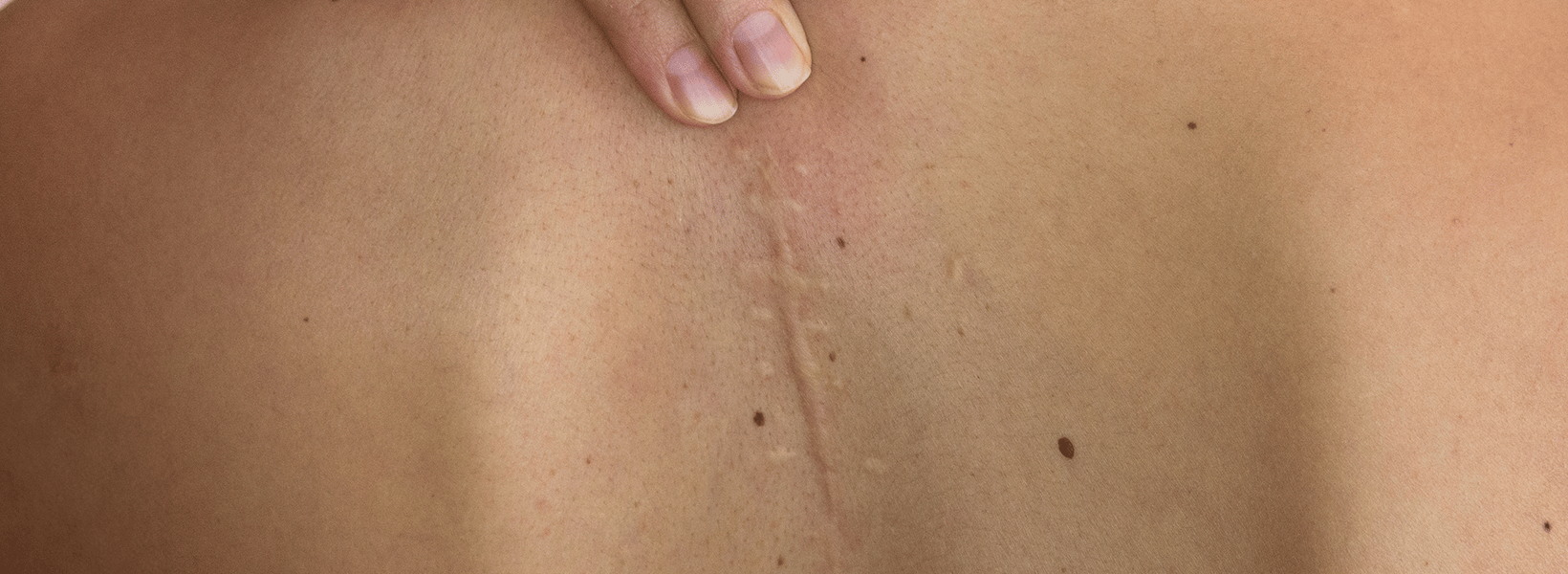 wound healing skin image